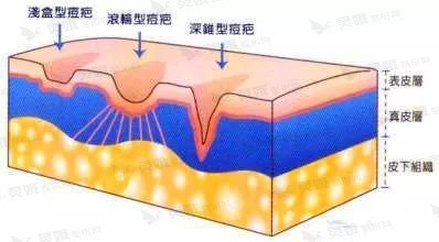 碘伏可以涂在痘痘上吗、简单好用的祛痘方法：激光祛痘